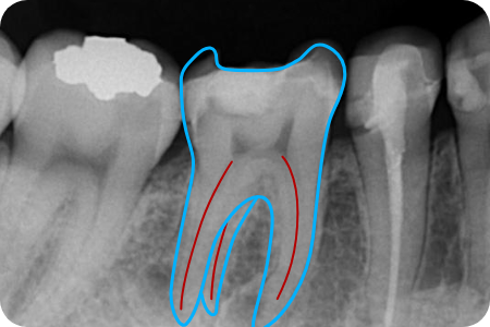 denta3